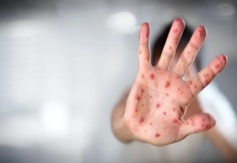 INSP: 282 DE CAZURI DE RUJEOLĂ ÎNREGISTRATE ÎN ULTIMA SĂPTĂMÂNĂ 
