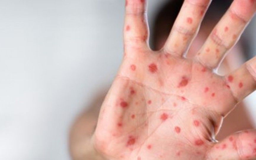 Creşte numărul cazurilor de rujeolă în Sălaj