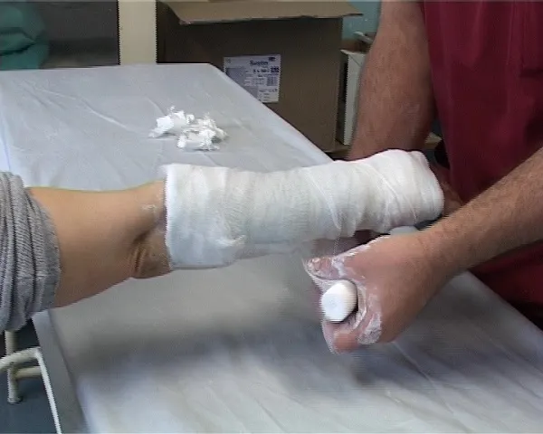 fractura